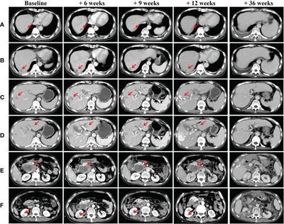 Hepatocellular carcinoma complicated with huge posterior pancreas head lymph node metastasis and primary renal carcinoma: A case report